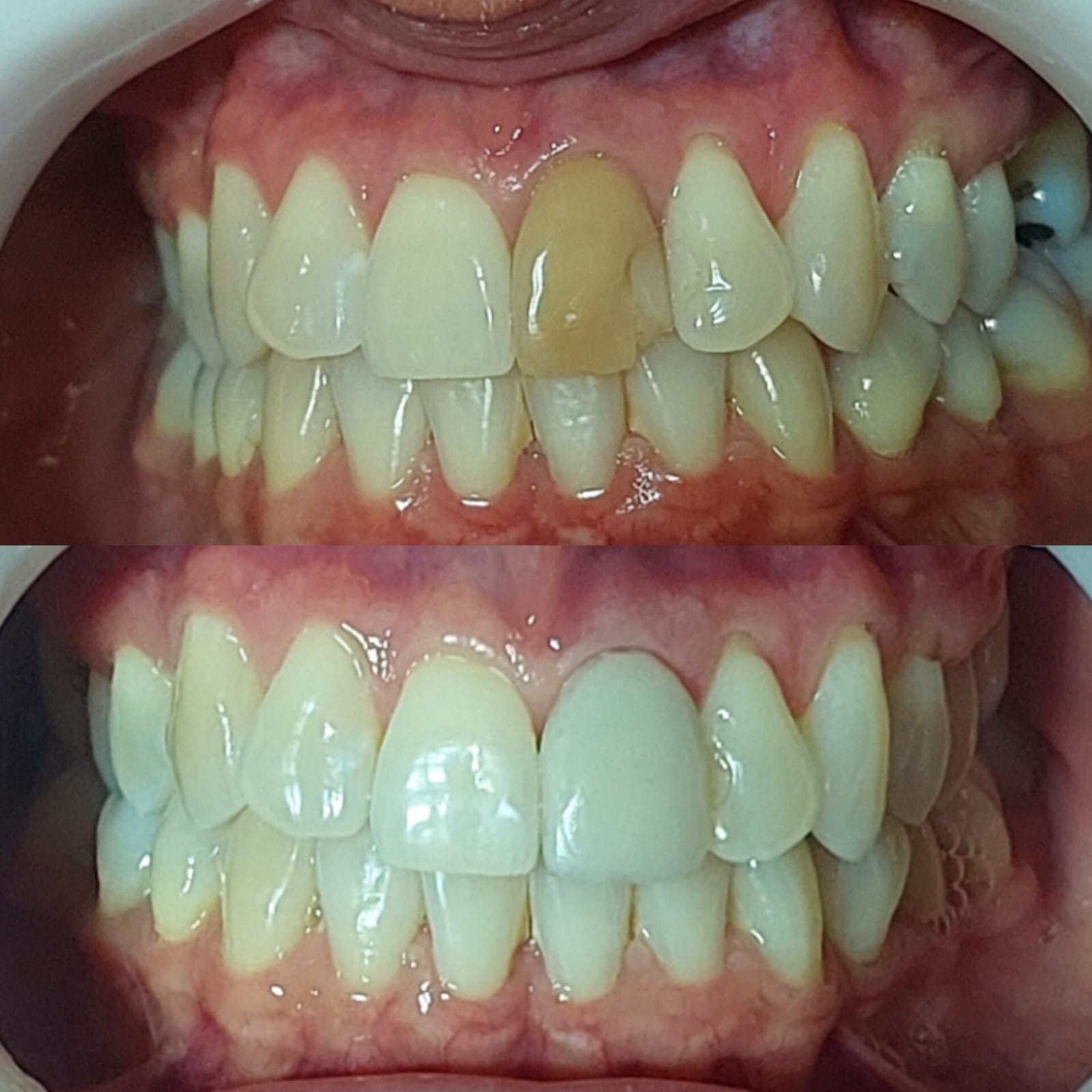 Antes e depois 2