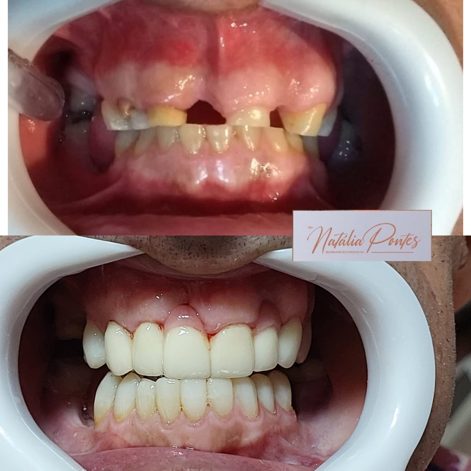 Antes e depois 4