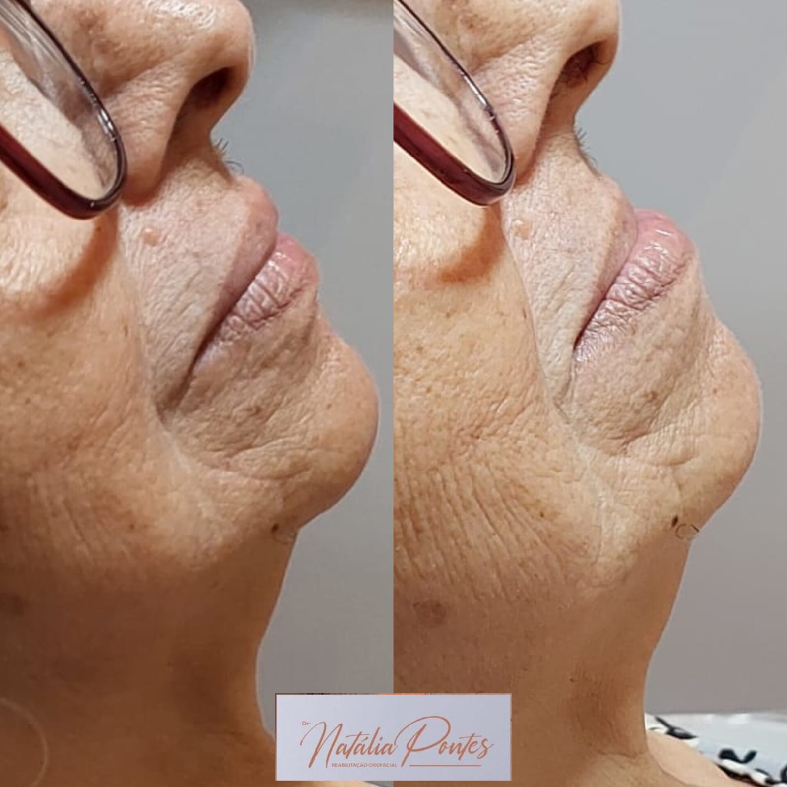 Antes e depois 6
